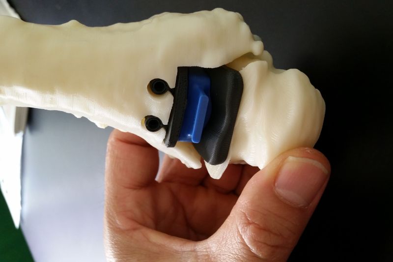 Caviglia ricostruita in 3D al Rizzoli di Bologna