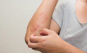 ROMA (ITALPRESS) - L'azienda biofarmaceutica AbbVie ha annunciato oggi che l'Agenzia Italiana del...