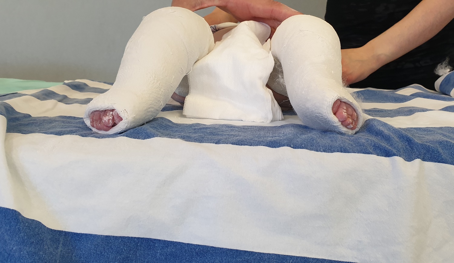 Piede torto congenito, al Rizzoli di Bagheria trattati anche bambini di sole due settimane