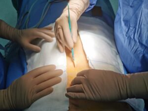 Un prelievo multiorgano (fegato, reni e cornee) e di tessuti è stato  eseguito al Policlinico “G...