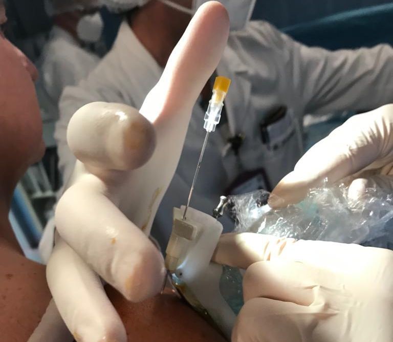 Policlinico di Palermo, cellule staminali per rigenerare tendini e articolazioni